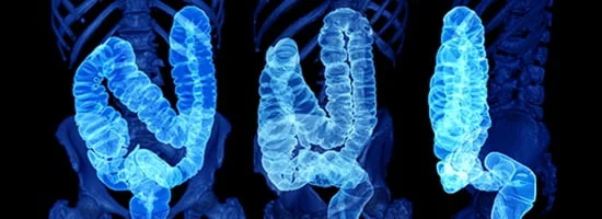 Colon cancer